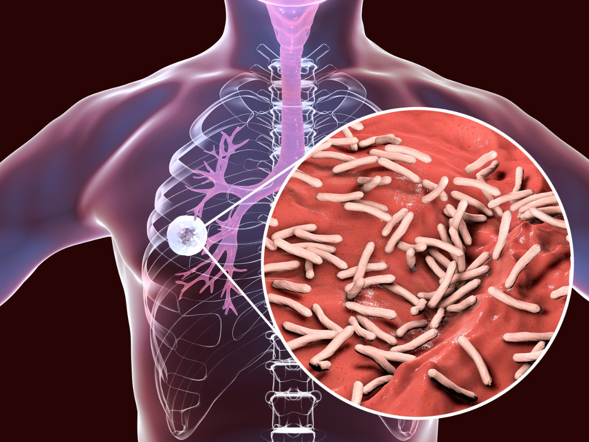 A simple urine test could detect lung cancer early. All you need to know