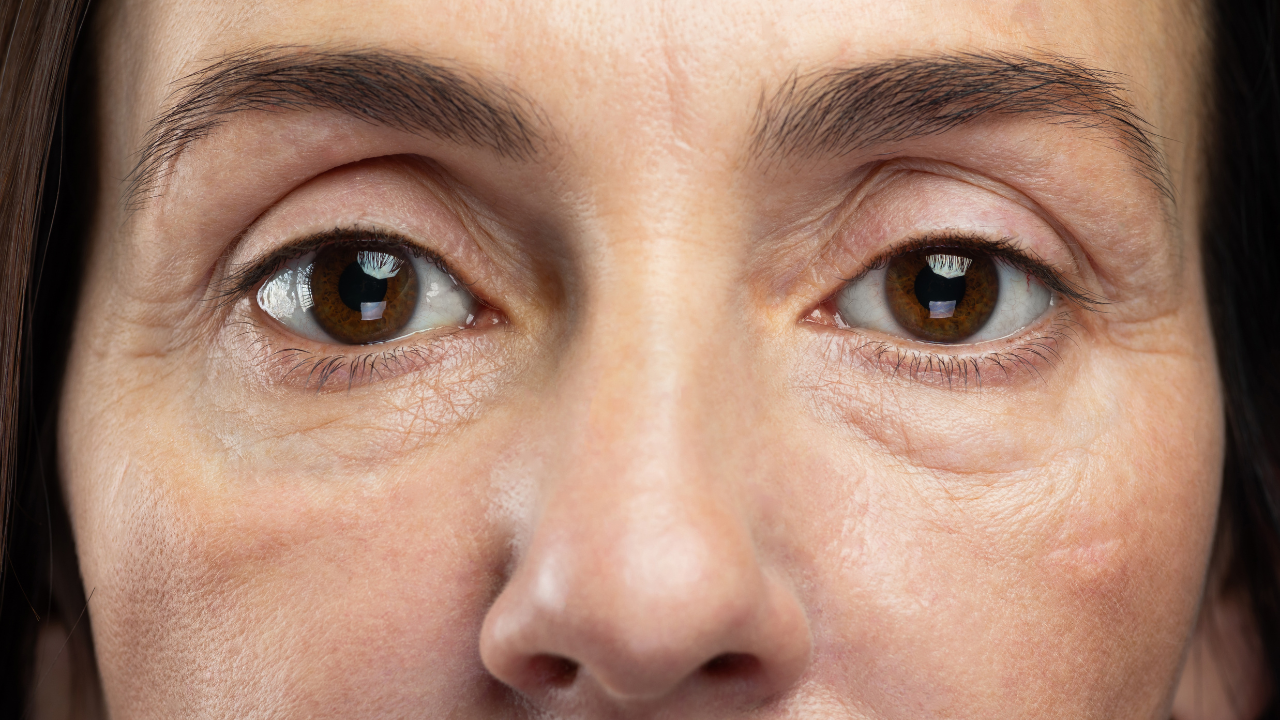 Puffy Eyes: Underlying causes of this health issue and how to treat it