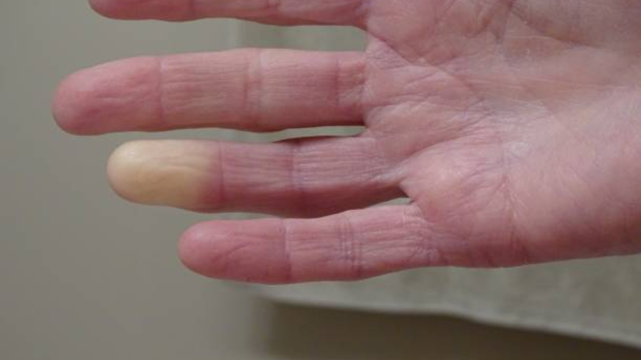 What triggers Raynaud’s phenomenon during winters and how can you manage it?