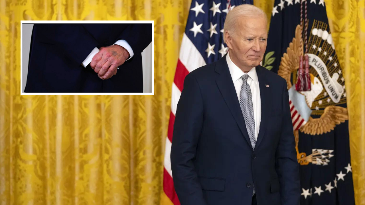 Biden's mysterious 'purple bruise' on left hand sparks online discussion: 'He is still pumped up by drugs'