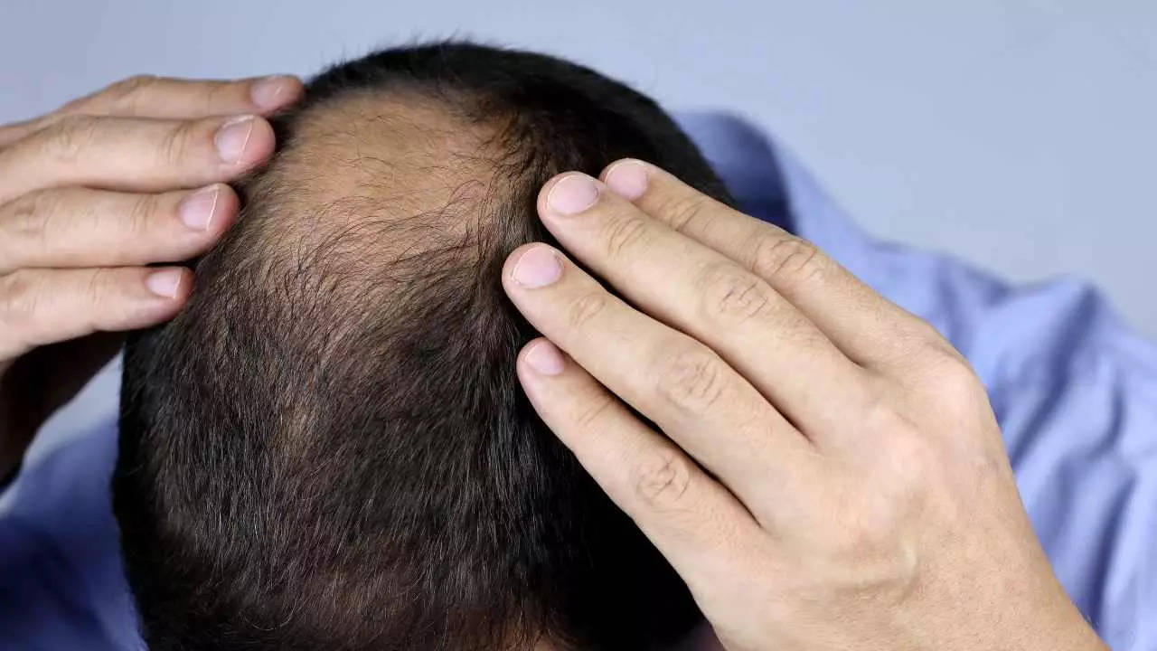 Bizarre ‘baldness virus’ hits several villages in India: Here’s why people are losing hair in this infection