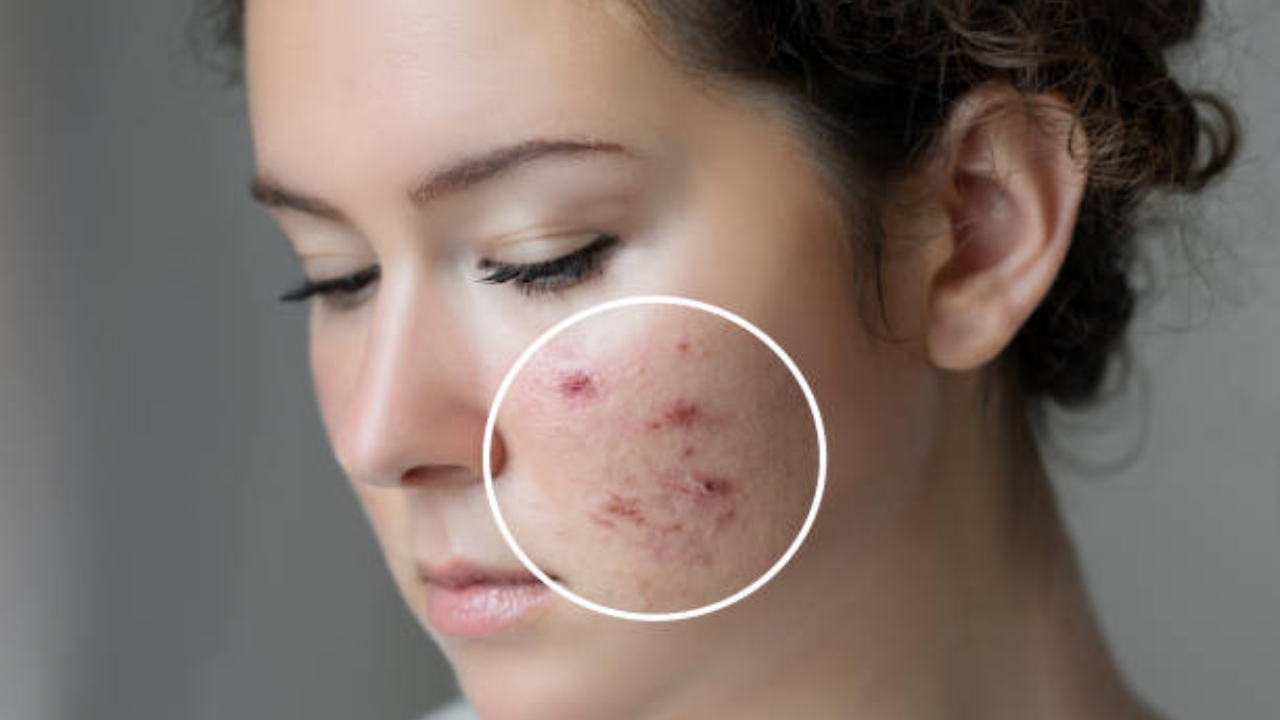 Acne during periods? Here are some tips to manage your skin