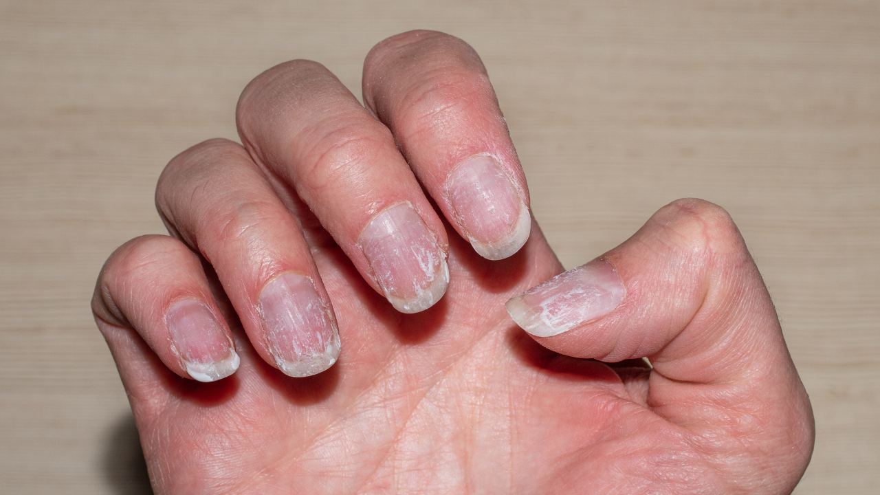 Ridges in nails can denote these 5 health risks