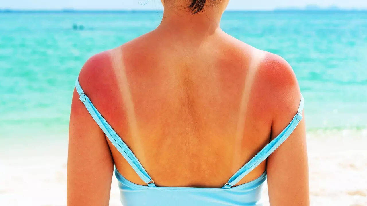 Sunburn (1)