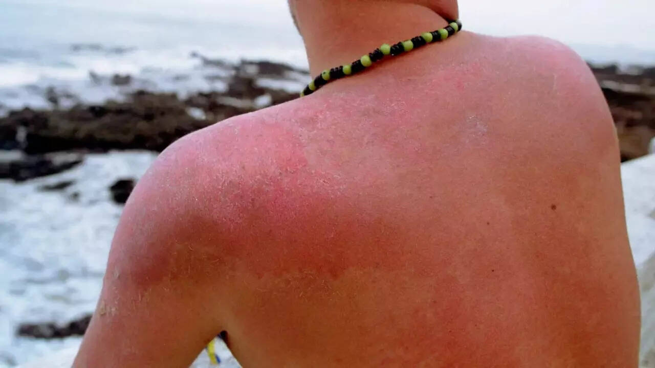 Sunburn (2)