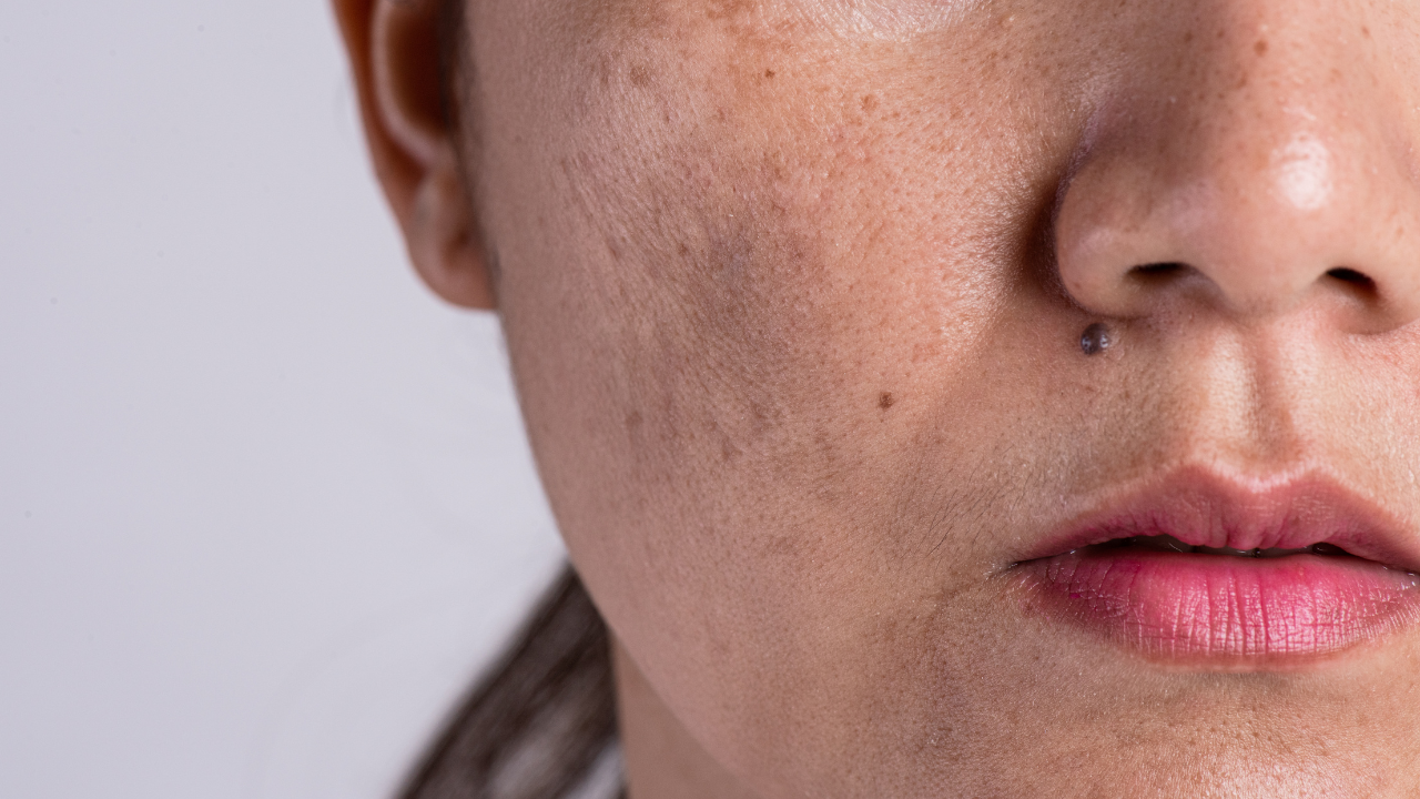 Complexion getting dark? This health issue may be the reason