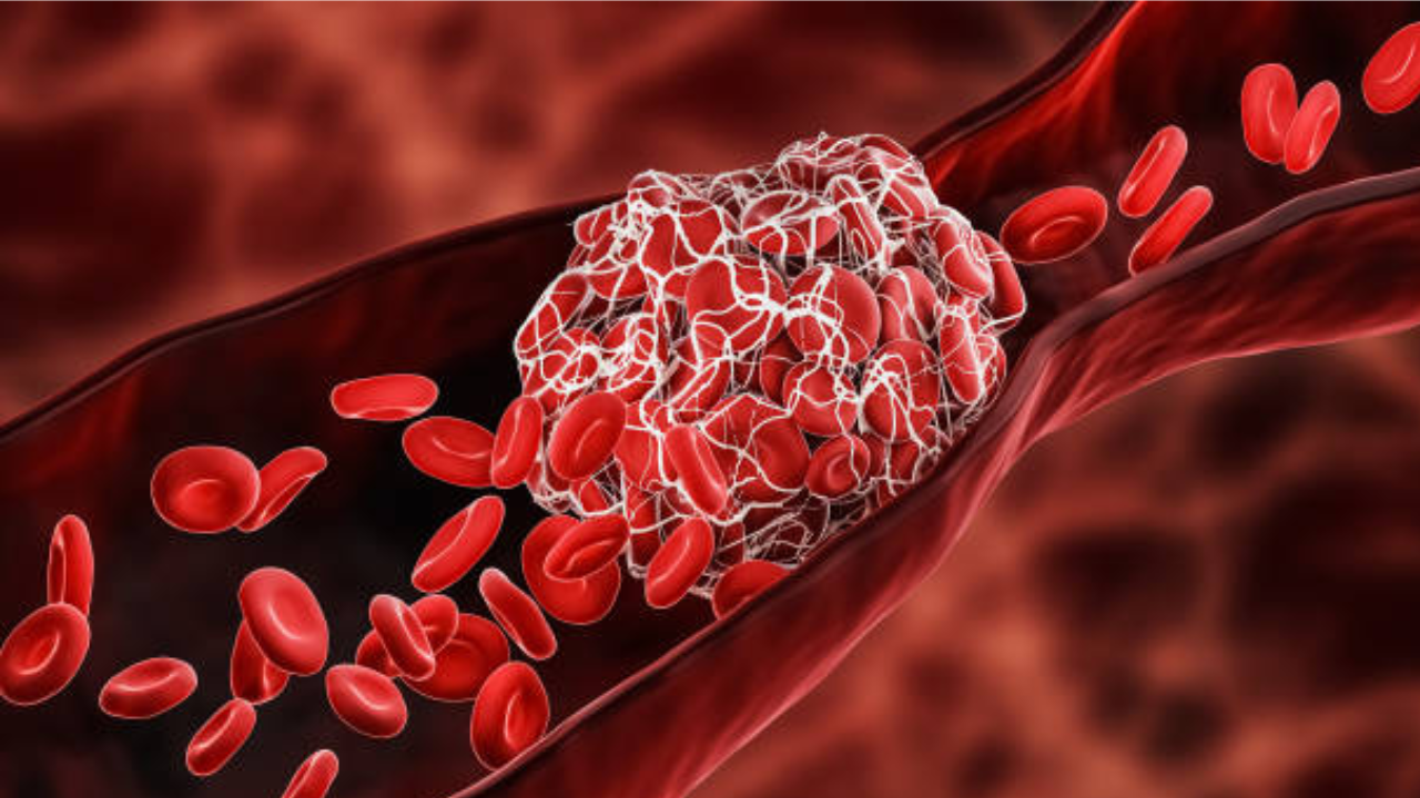 Which is the most common body part to get a blood clot (why is it so and how to avoid this)