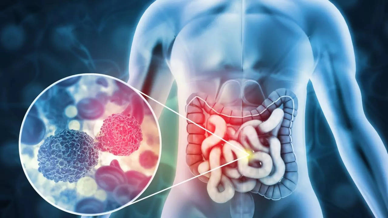 Medical miracle? Experimental drug wipes out colorectal cancer completely in trial