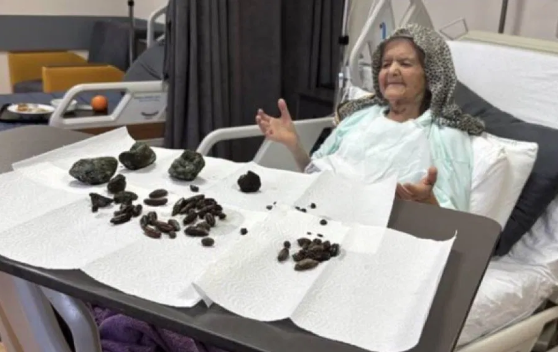 Doctors find 28 date seeds, 35 olive pits and 5 fist sized objects in 92-year-old’s stomach