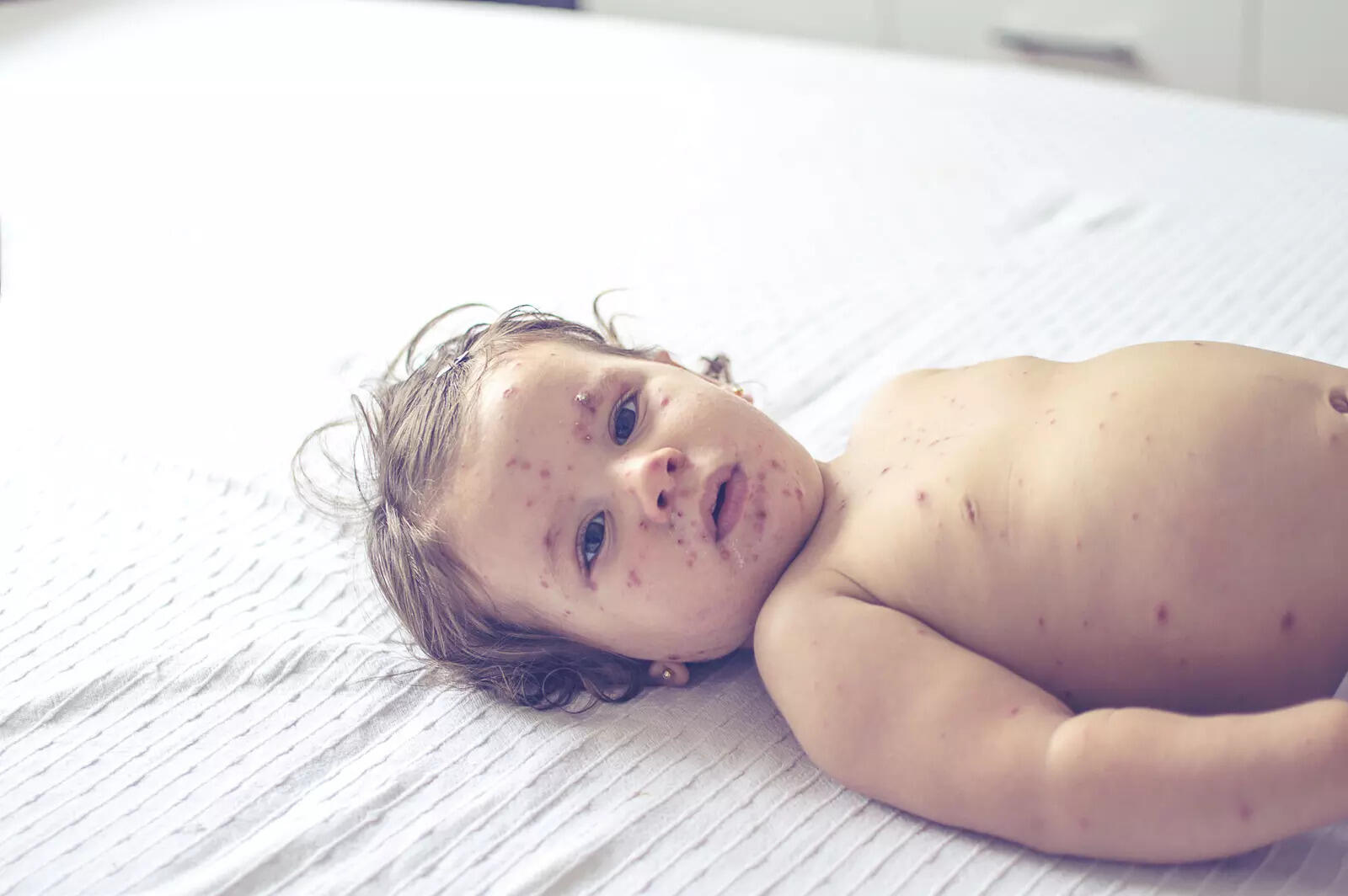 measles