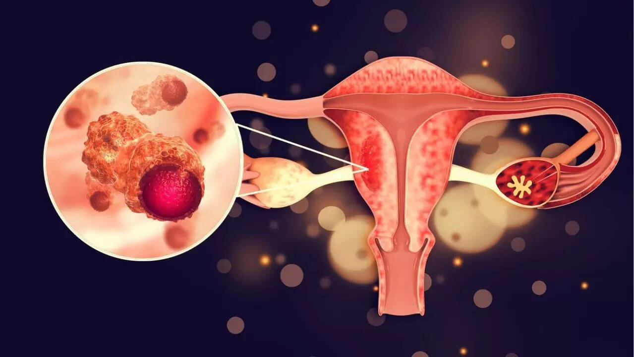 ovarian cancer 2