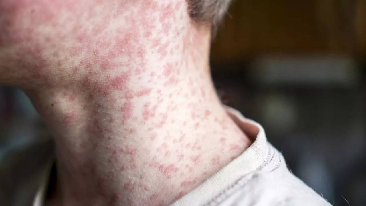 measles 3