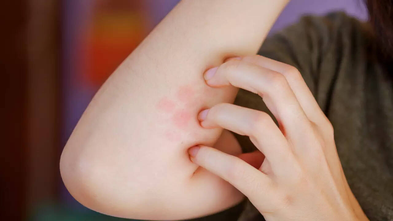 ringworm