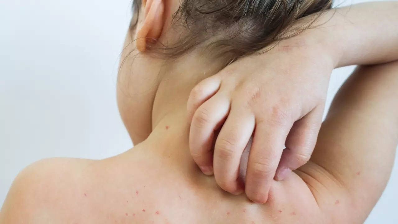 Measles (1)