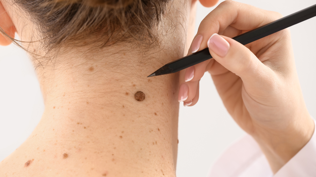 Moles Check: 6 reasons to get your newly occuring moles checked by a doctor