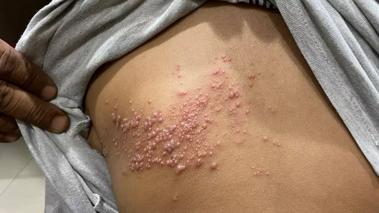 SHINGLES