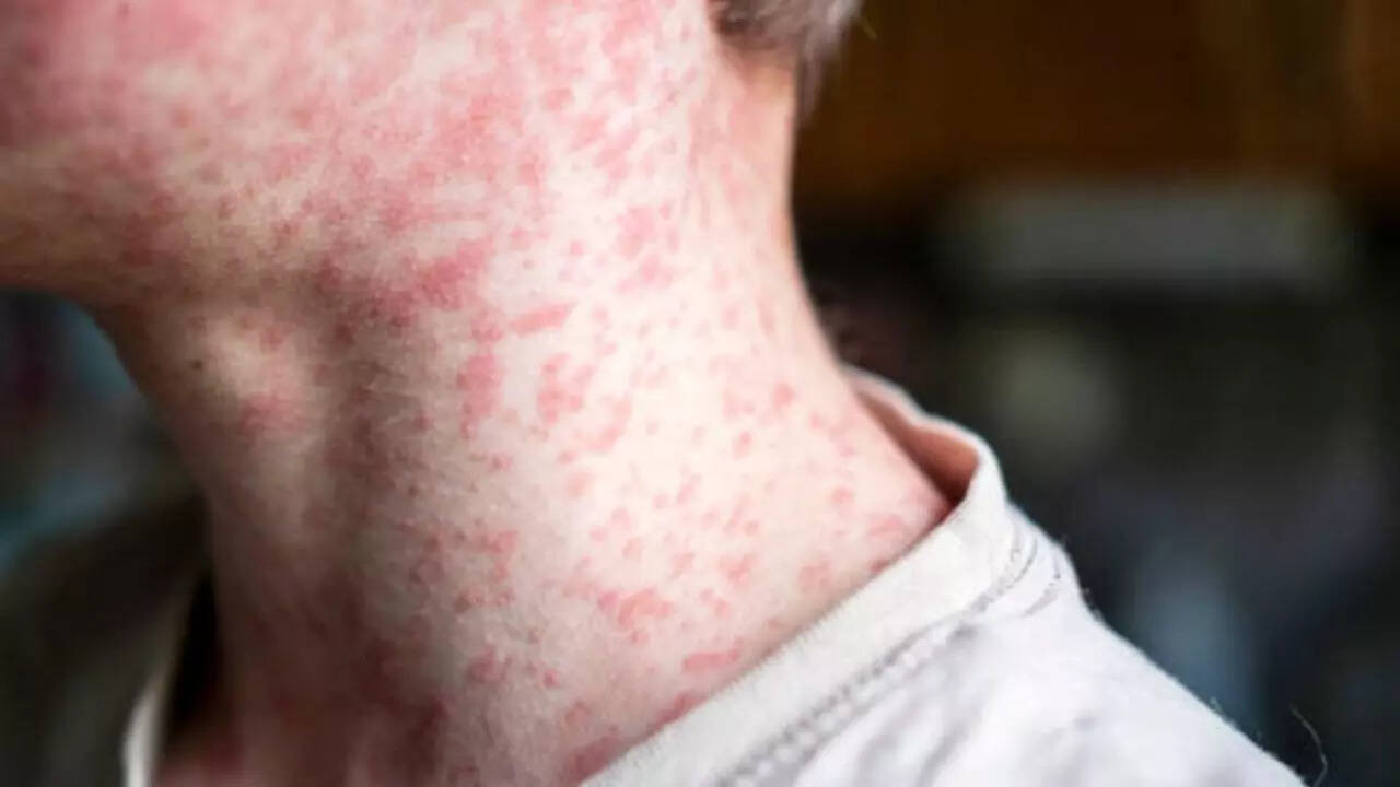 Symptoms of measles