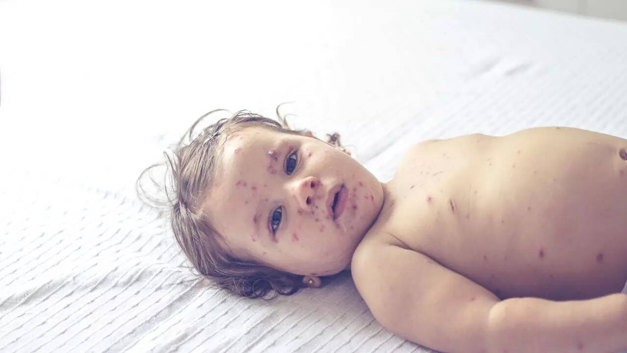 measles outbreak