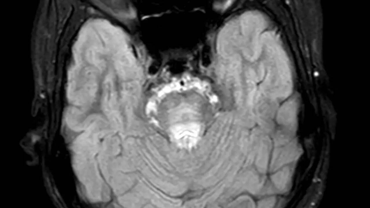 What is Wilson's Disease?