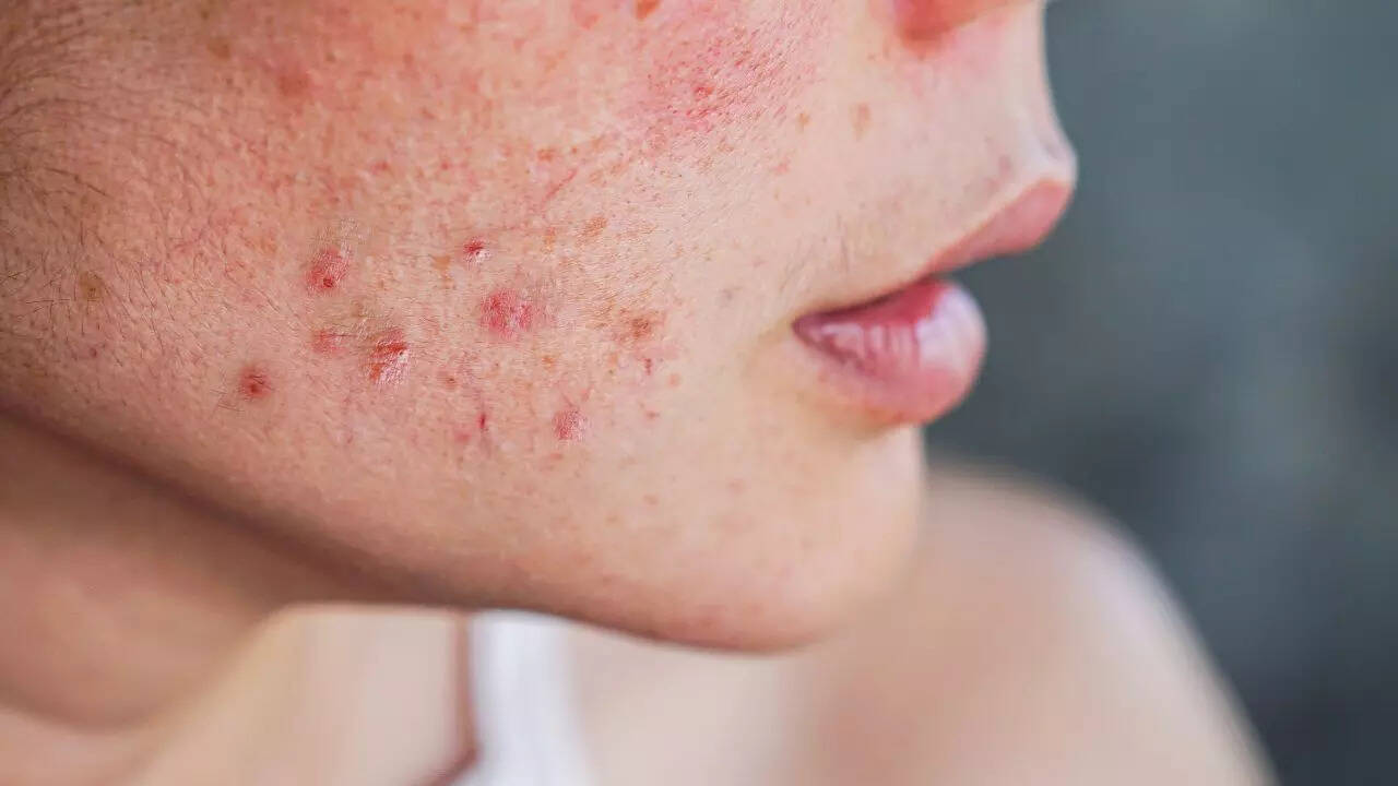 Employee with flawless skin quits over one pimple: What happened
