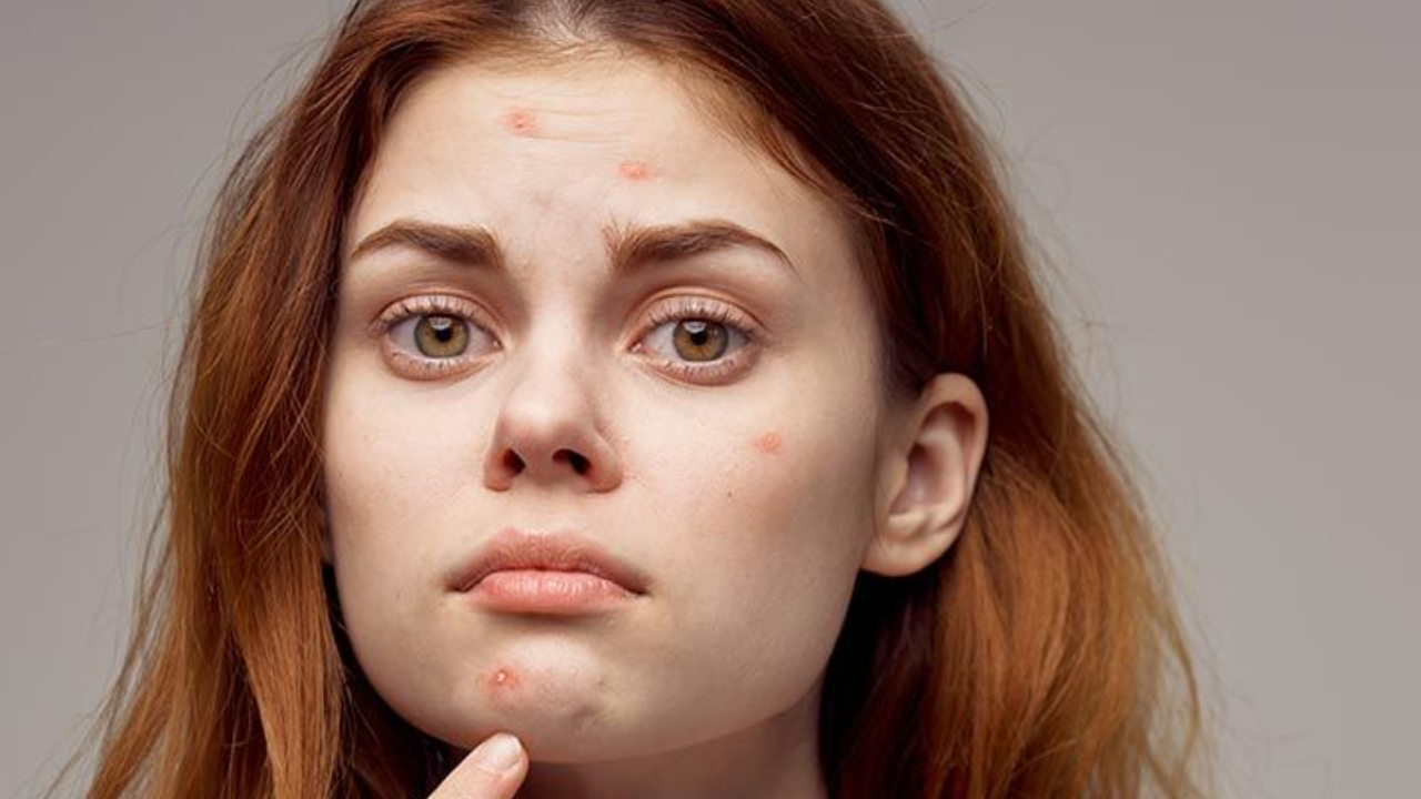 Are mangoes the cause of your pimples?
