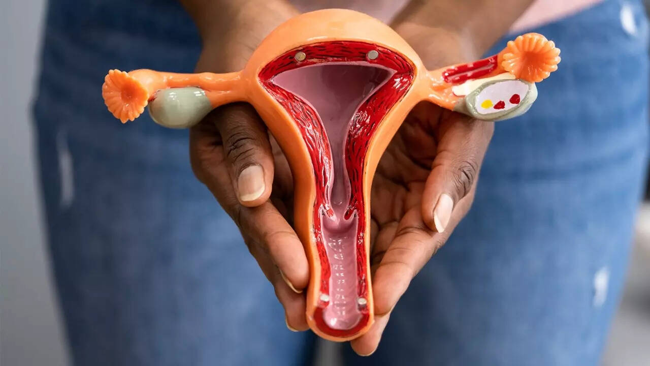 Ovarian cancer (1)
