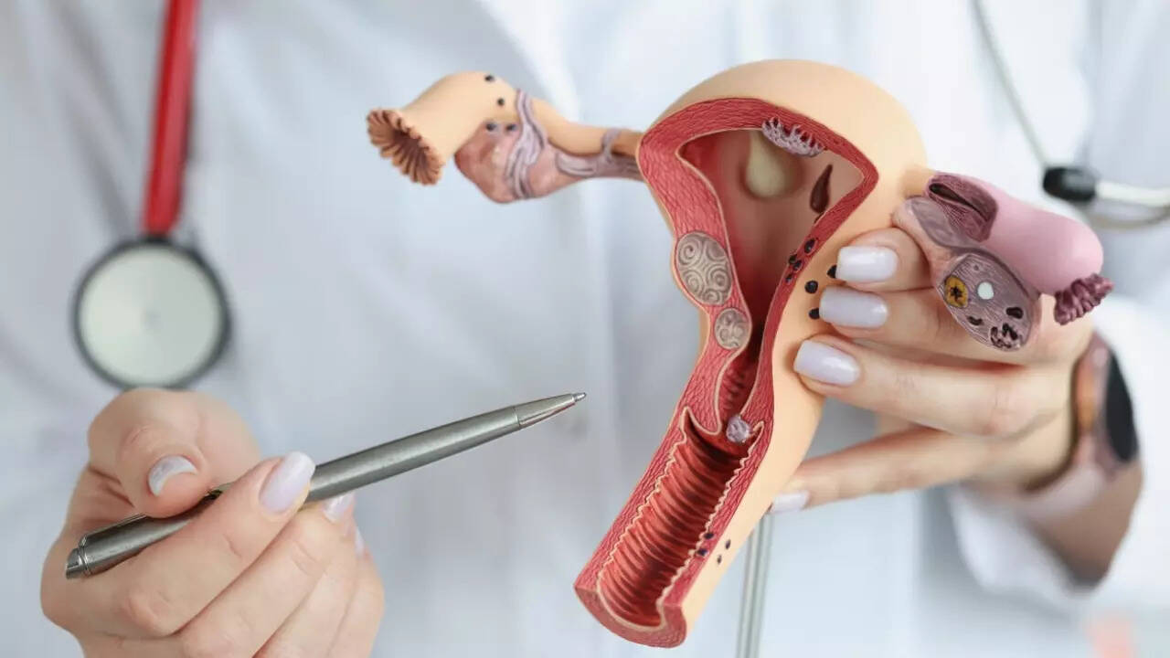 Ovarian cancer (4)