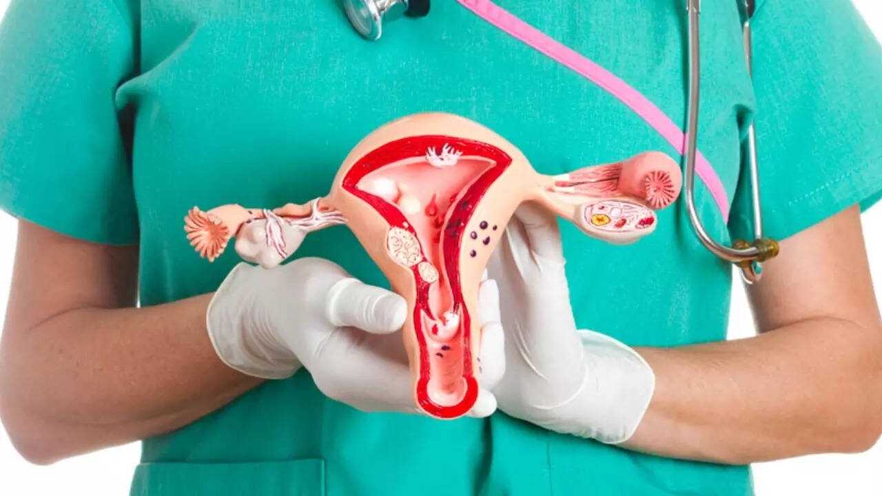 Ovarian cancer (3)