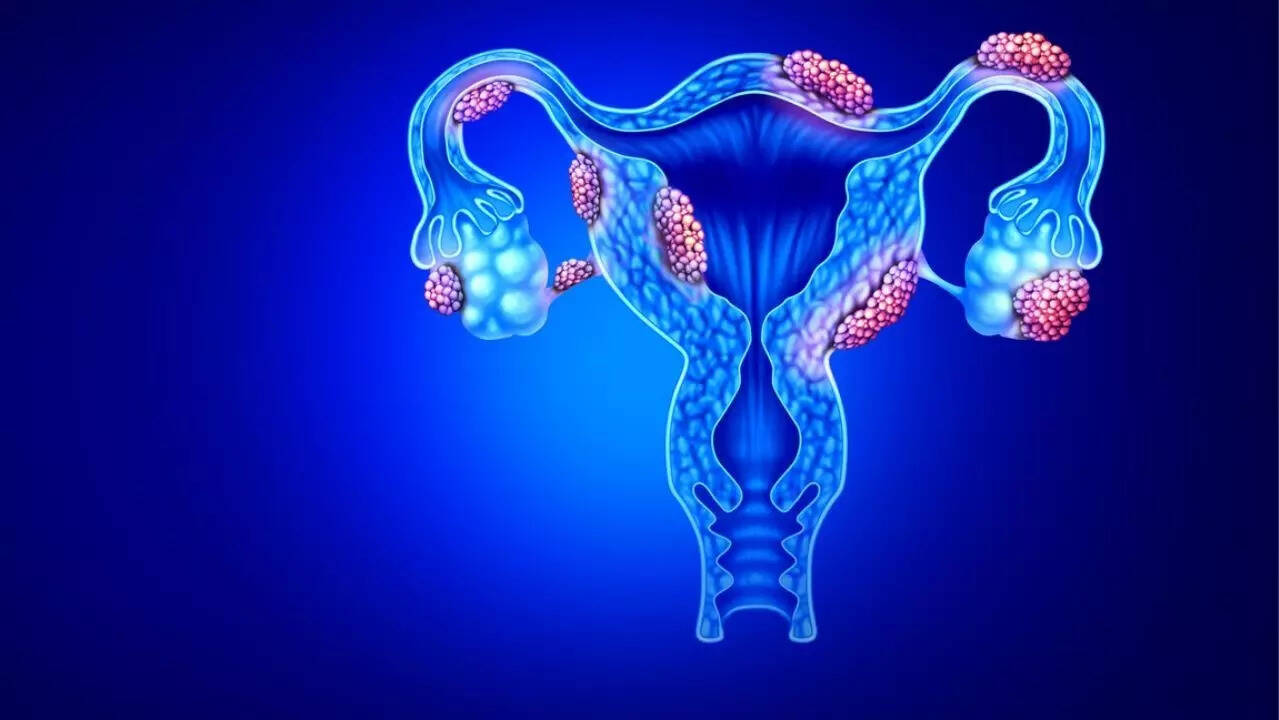 endometeriosis