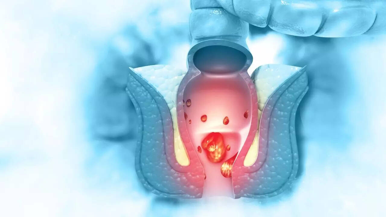 anal cancer 3