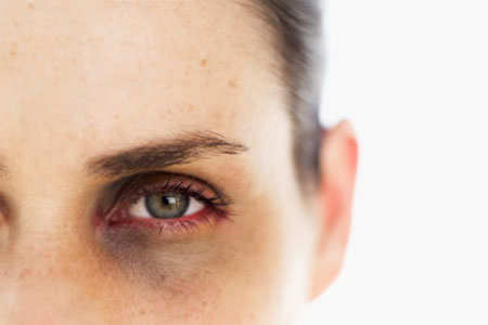 The Truth About Dark Circles - Times Of India