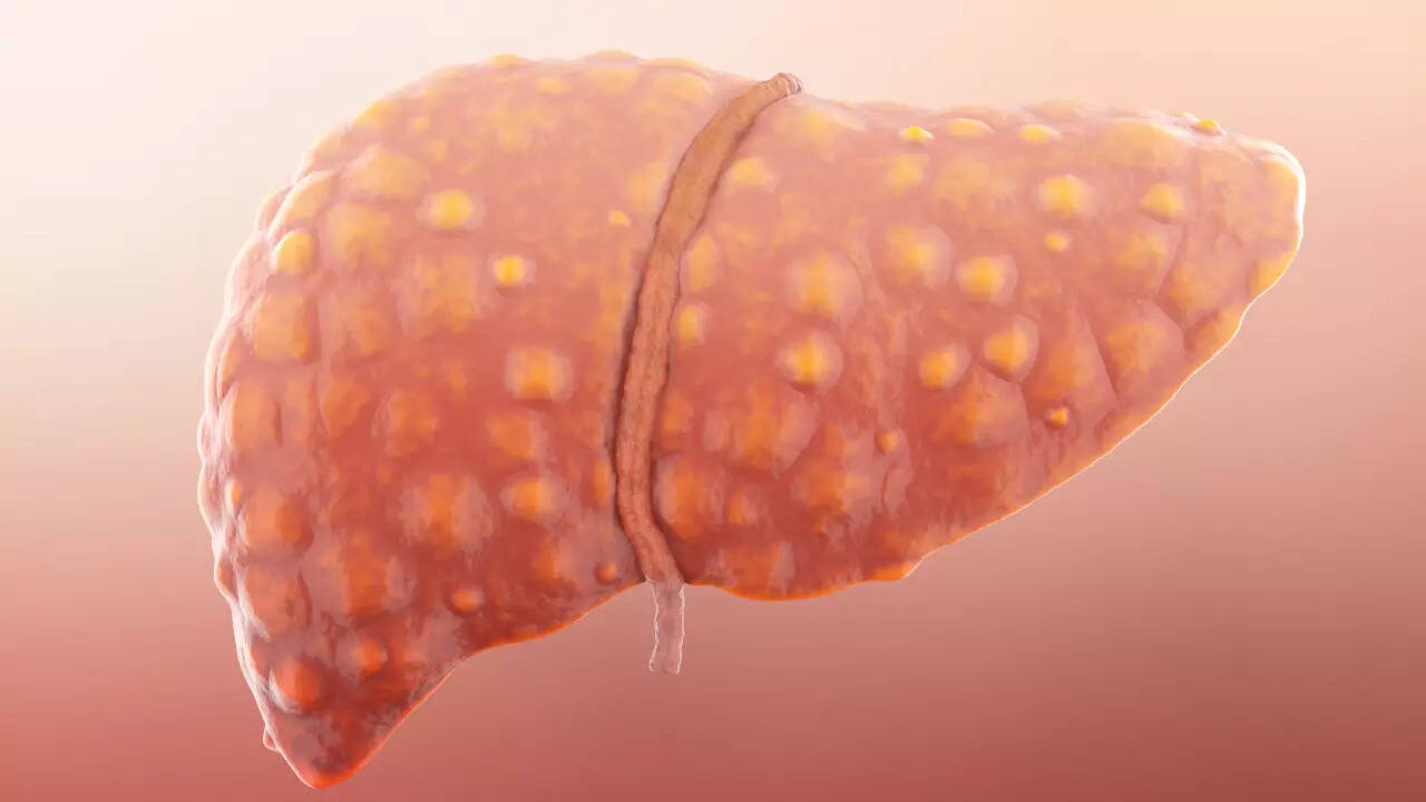 cirrhosis