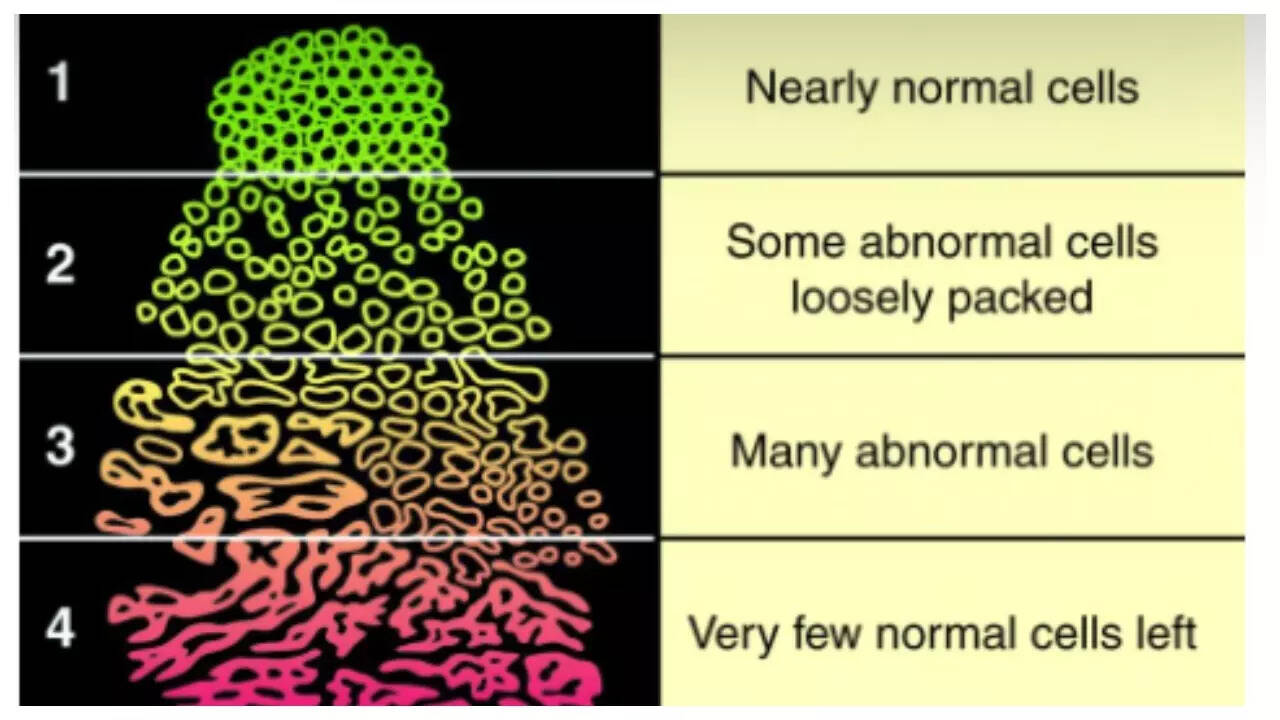 What is the Gleason score in prostate Cancer and why early testing is crucial