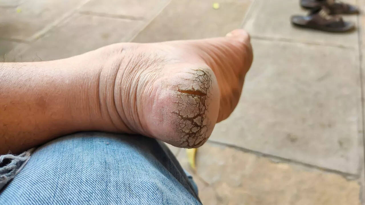 cracked feet