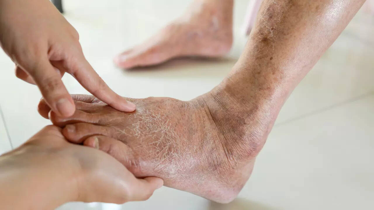 swollen feet