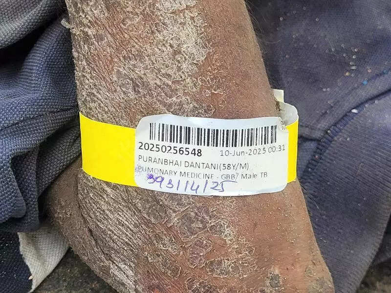 Two TB patients ‘thrown out’ of Civil