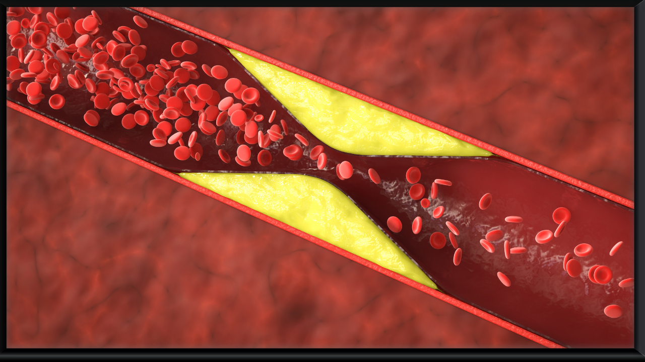 5 silent symptoms of high cholesterol that may go unnoticed