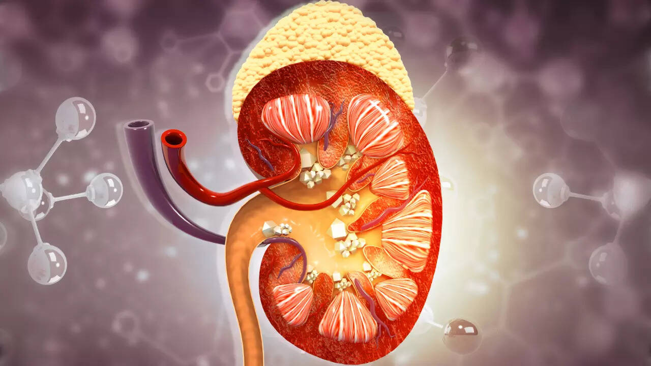 kidney stones