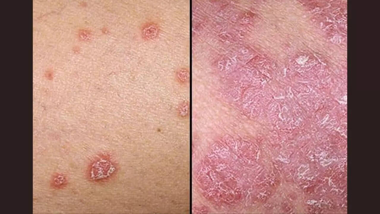 What is psoriasis
