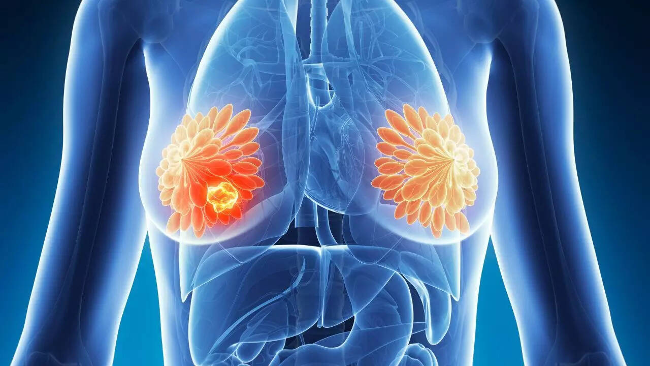 How breast cancer spreads in the body