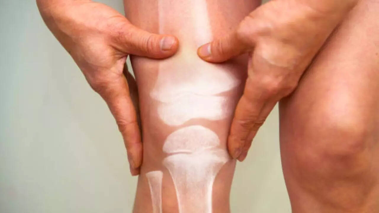 Osteoporosis is a bone disease