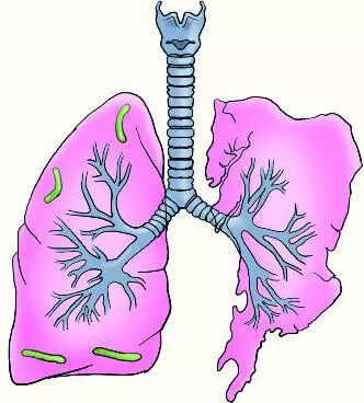 3 kids die of TB as general physicians miss early signs