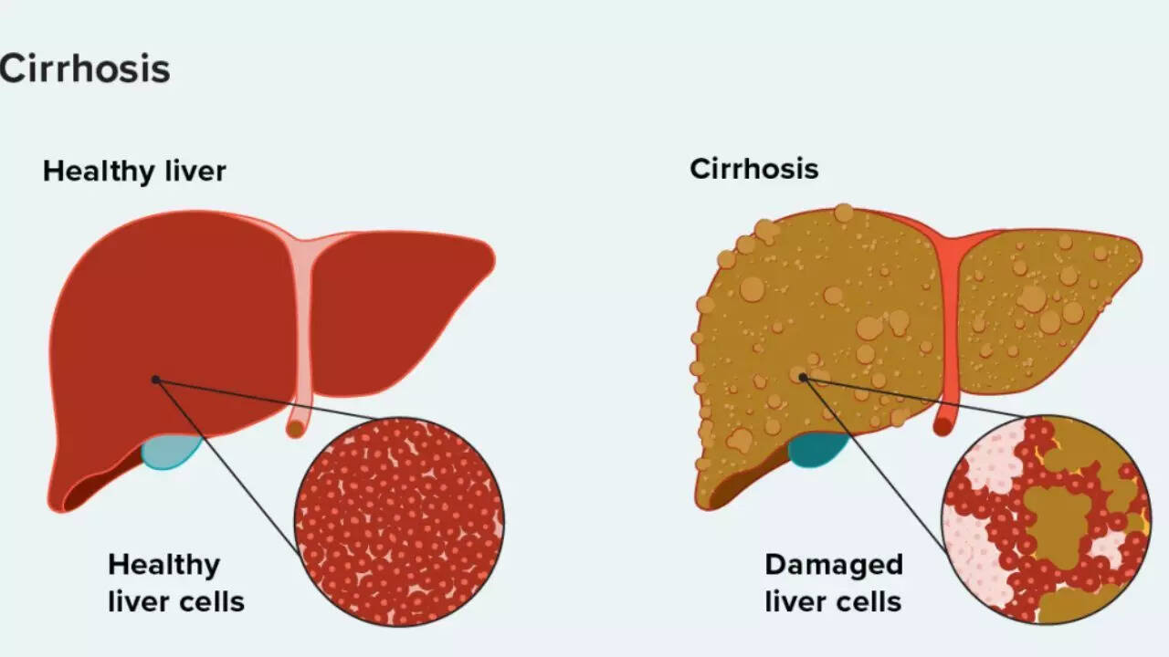 What is liver cirrhosis