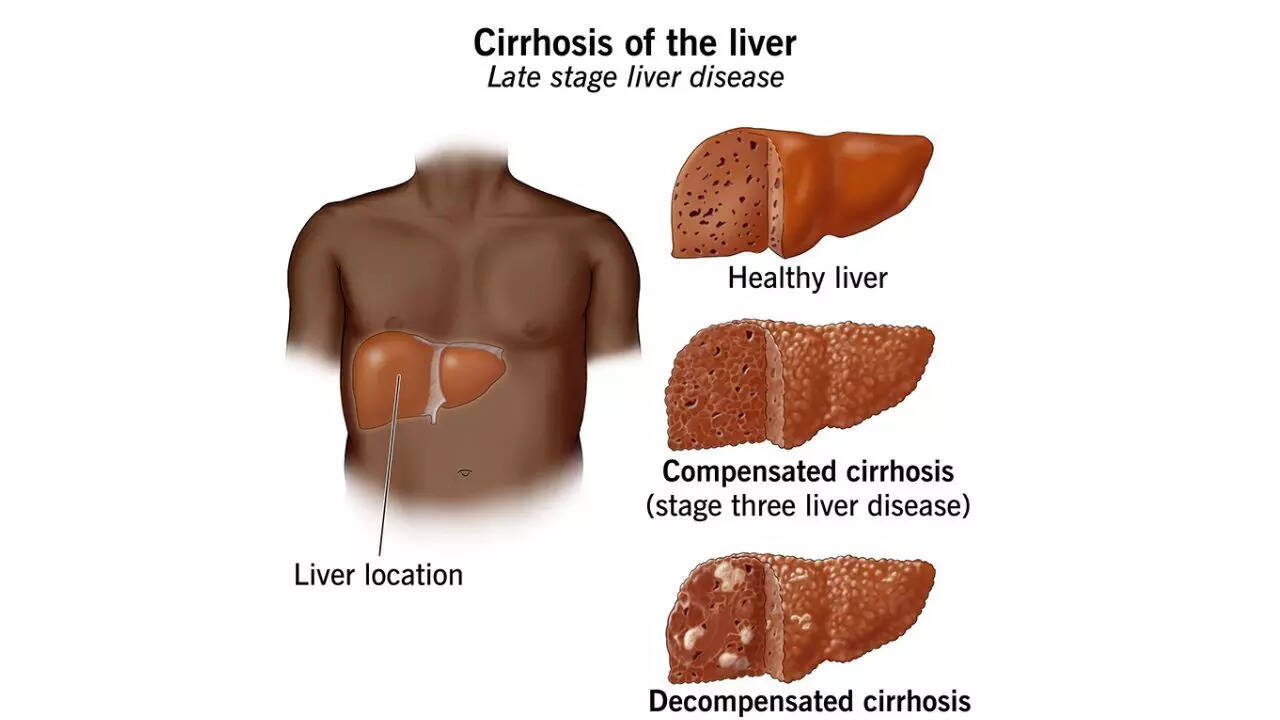 Liver cirrhosis stages