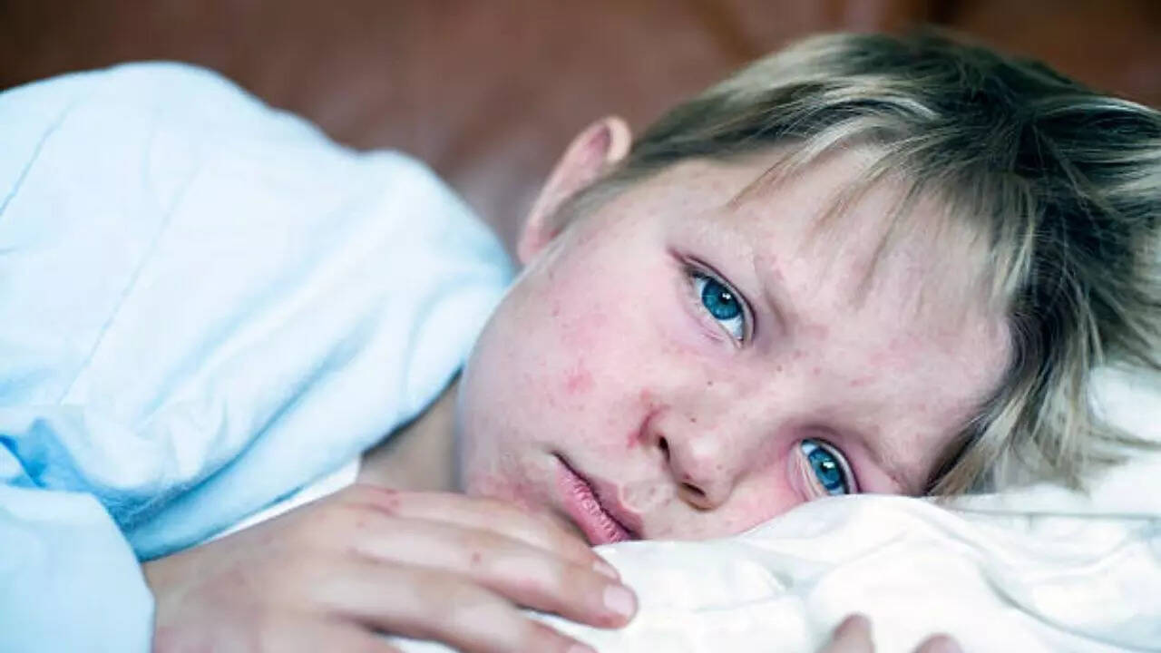 Symptoms of measles usually begin 7 to 14 days after the infection