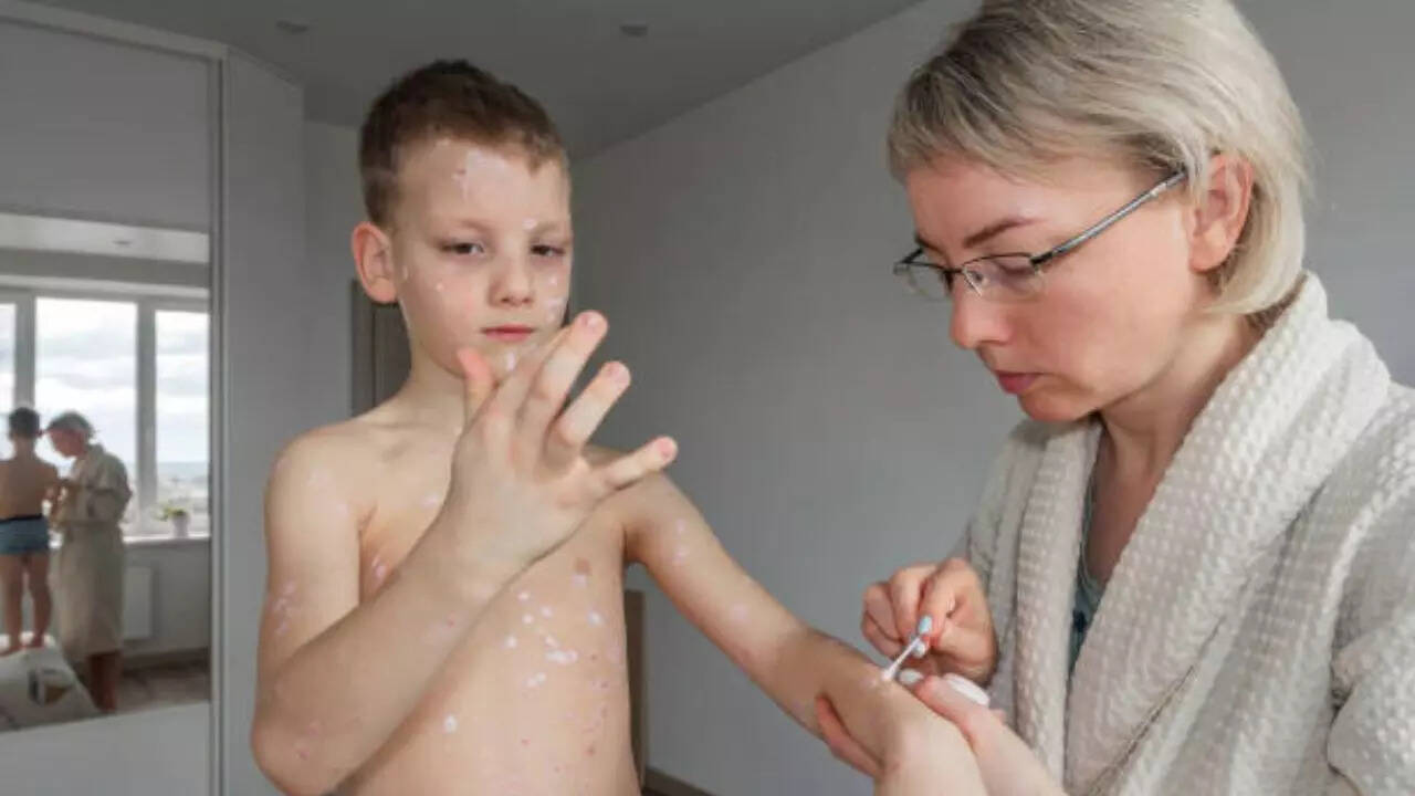 What are the risk zones for Measles spread?