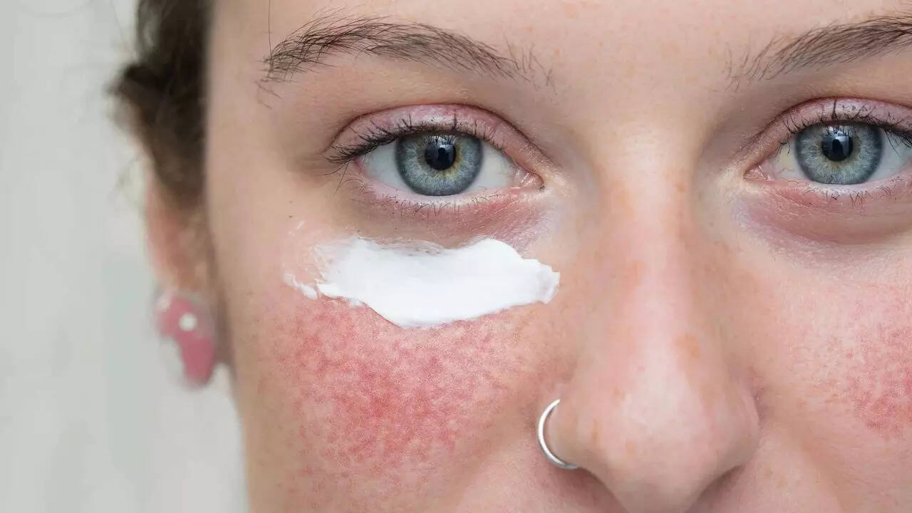 Acne (4)
