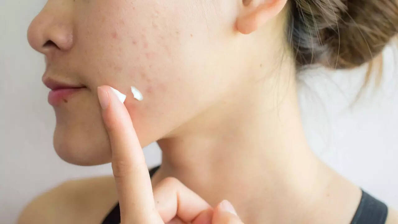 Acne (3)
