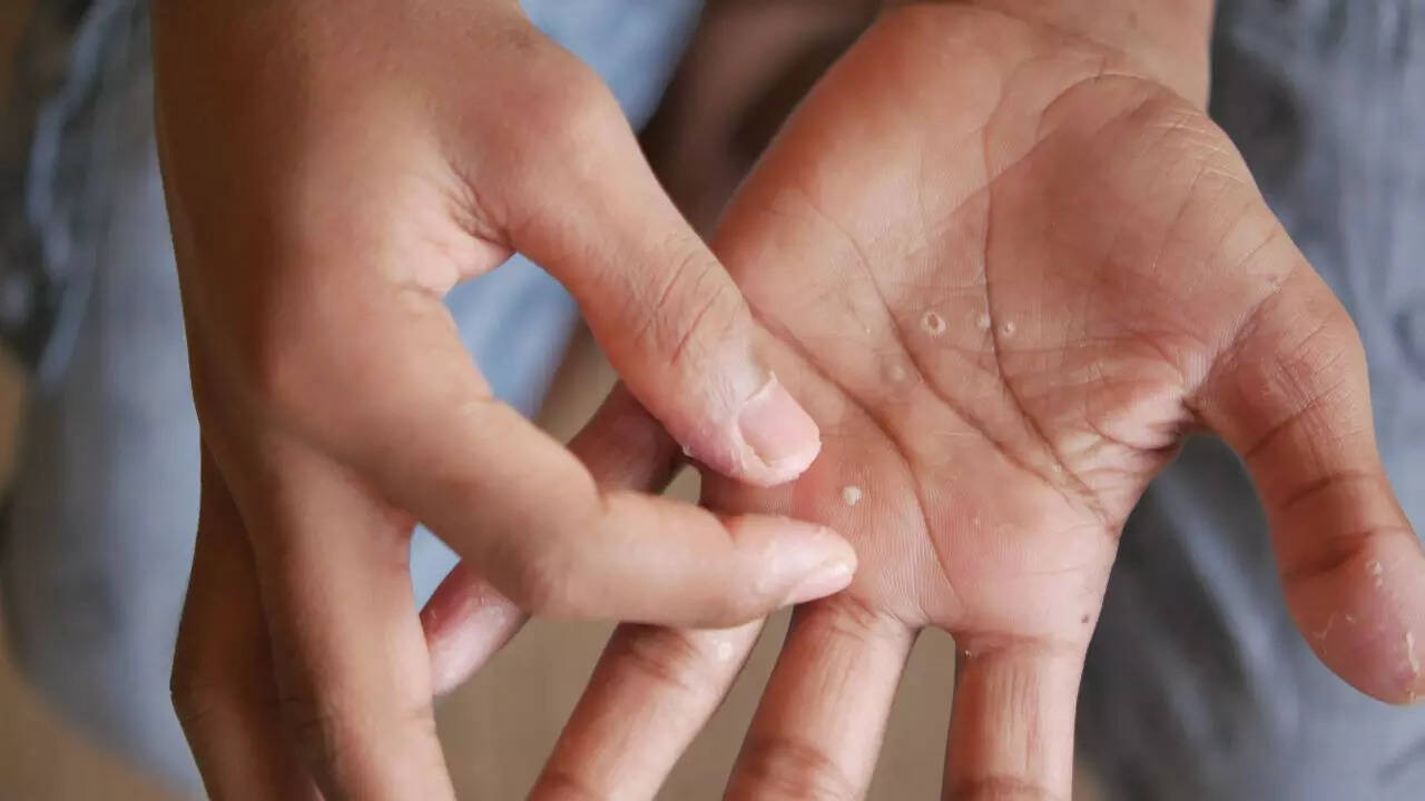 Dry Skin
