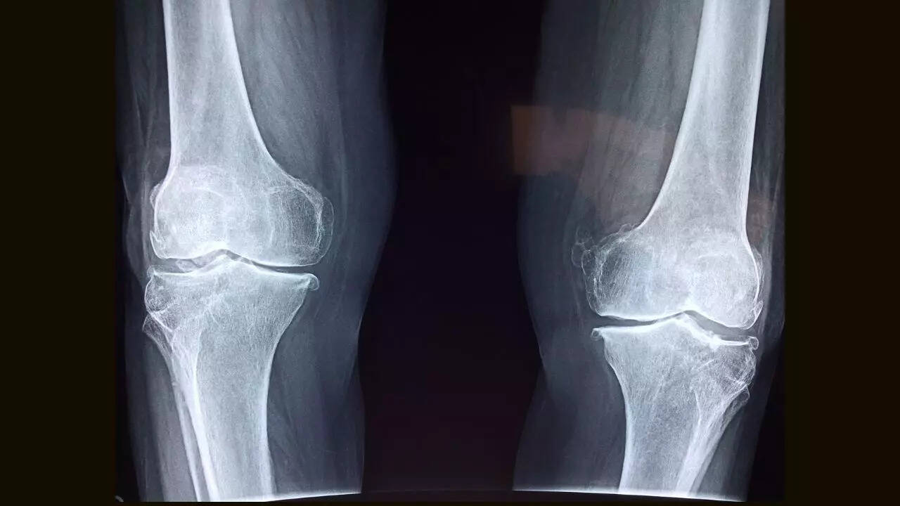 Broken bones